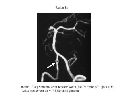 Resim 1a Resim 1. Sağ vertebral arter fenestrasyonu (ok). 3D time of flight (TOF) MRA incelemesi. a) MIP b) kaynak görüntü.