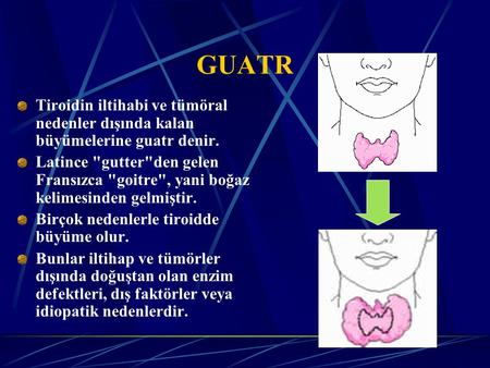   GUATR Tiroidin iltihabi ve tümöral nedenler dışında kalan büyümelerine guatr denir. Latince gutterden gelen Fransızca goitre, yani boğaz kelimesinden.