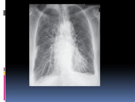 İlk grafide muhtemelen pulmoner fibrozise bağlı kaba retiküler patern izleniyor.Bu hastada geçirilmiş kardiak cerrahi ve KOAH öyküsü mevcuttur.Altta.