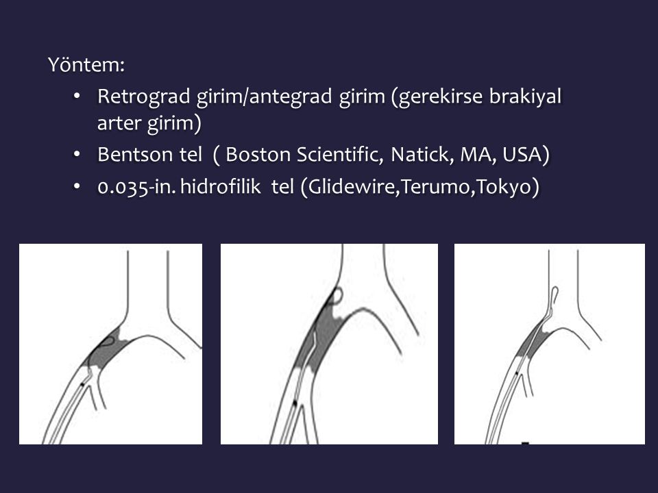 Yöntem: Retrograd girim/antegrad girim (gerekirse brakiyal arter girim) Bentson tel ( Boston Scientific, Natick, MA, USA)