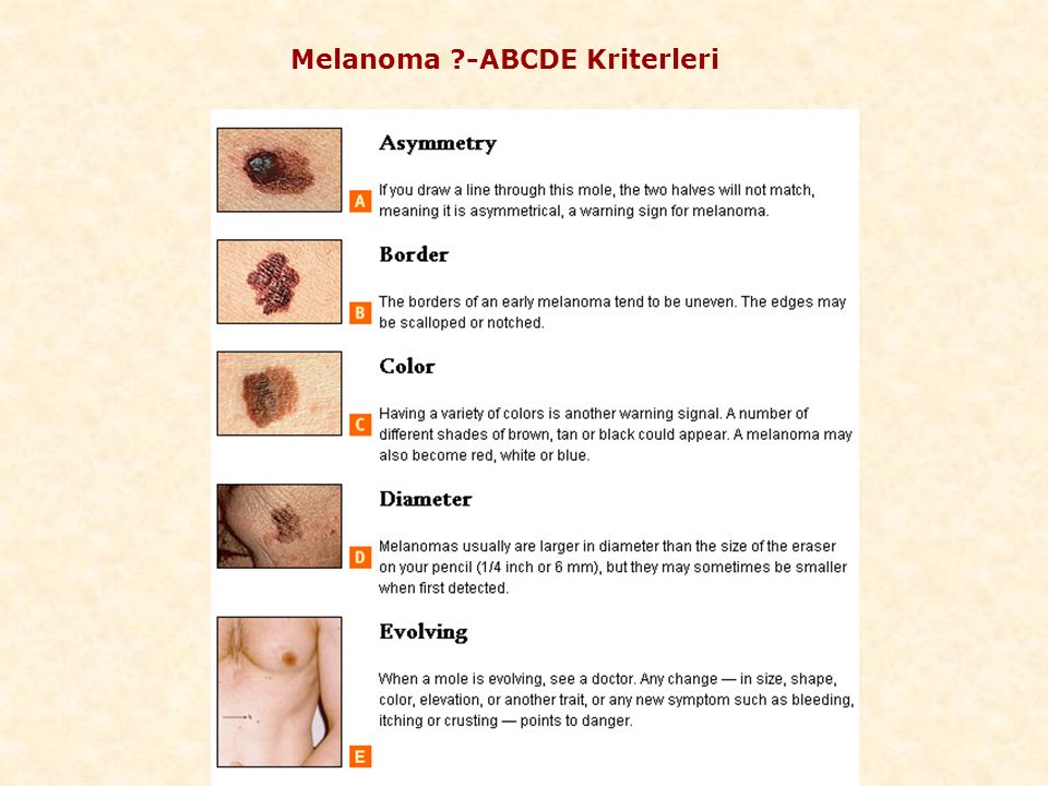 Melanoma -ABCDE Kriterleri