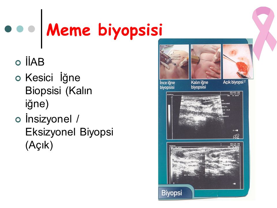 Meme biyopsisi İİAB Kesici İğne Biopsisi (Kalın iğne)