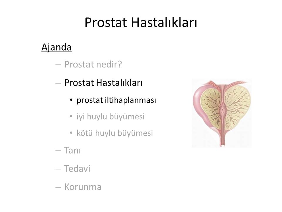 Prostat Hastalıkları Ajanda Prostat nedir Prostat Hastalıkları Tanı