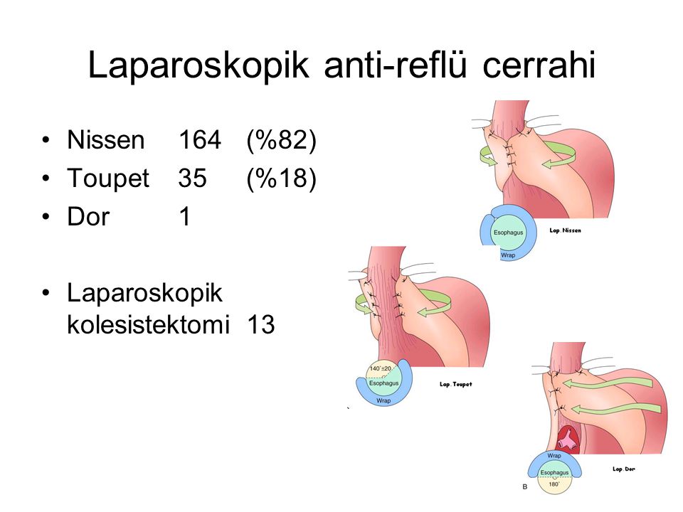 Laparoskopik anti-reflü cerrahi