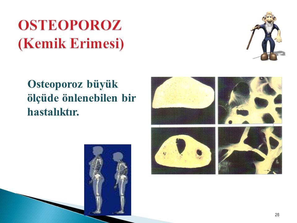 OSTEOPOROZ (Kemik Erimesi)
