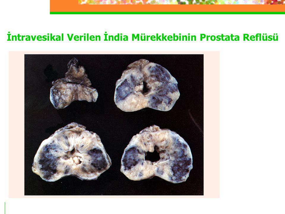 İntravesikal Verilen İndia Mürekkebinin Prostata Reflüsü