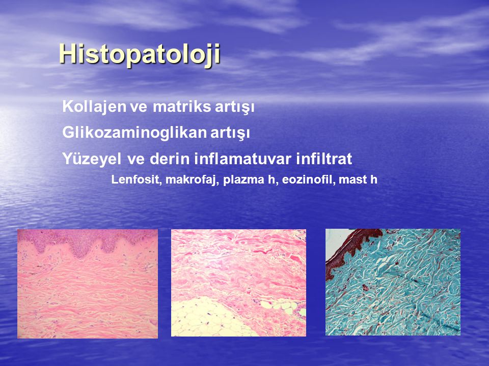 Histopatoloji Kollajen ve matriks artışı Glikozaminoglikan artışı