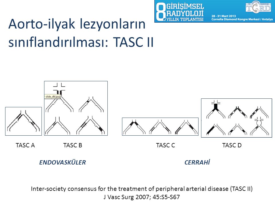Aorto-ilyak lezyonların sınıflandırılması: TASC II