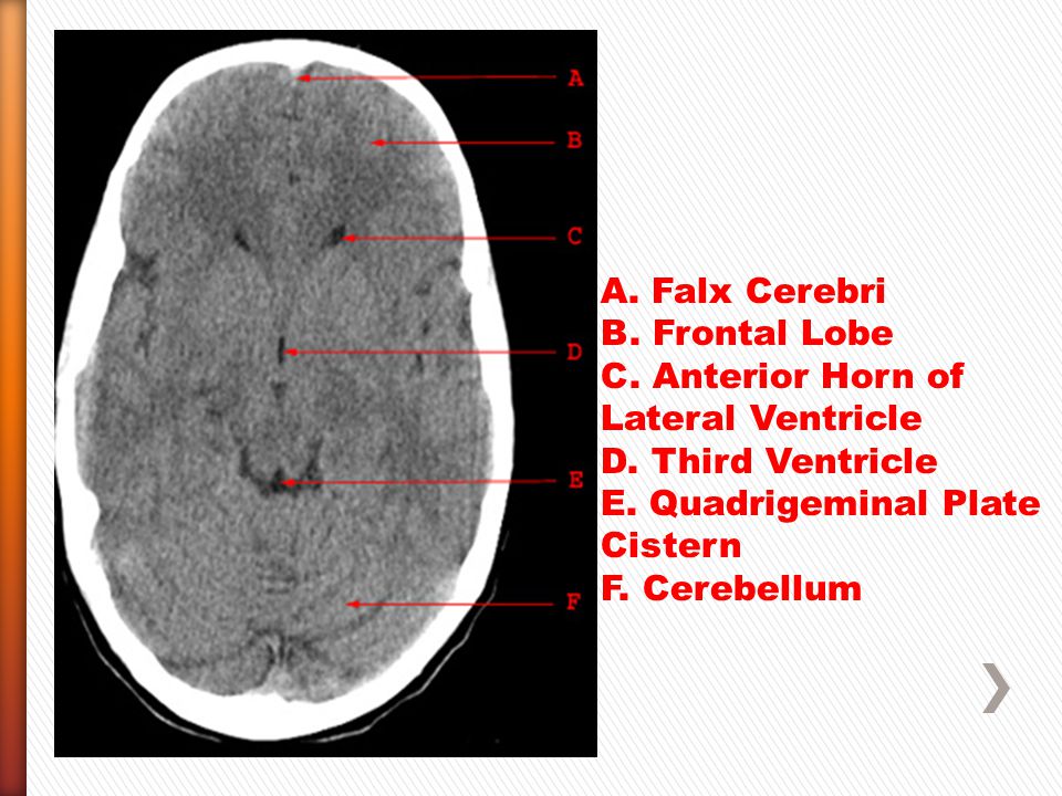 Falx cerebri penetration