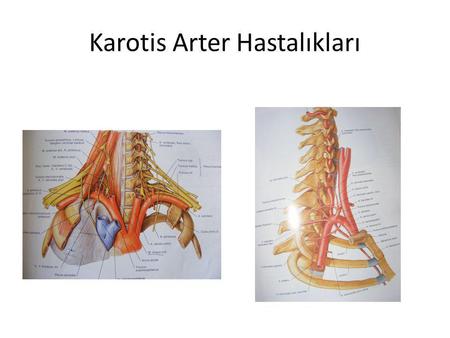 Karotis Arter Hastalıkları