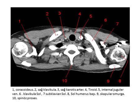 1, coracoideus. 2, sağ klavikula. 3, sağ karotis arter. 4, Tiroid