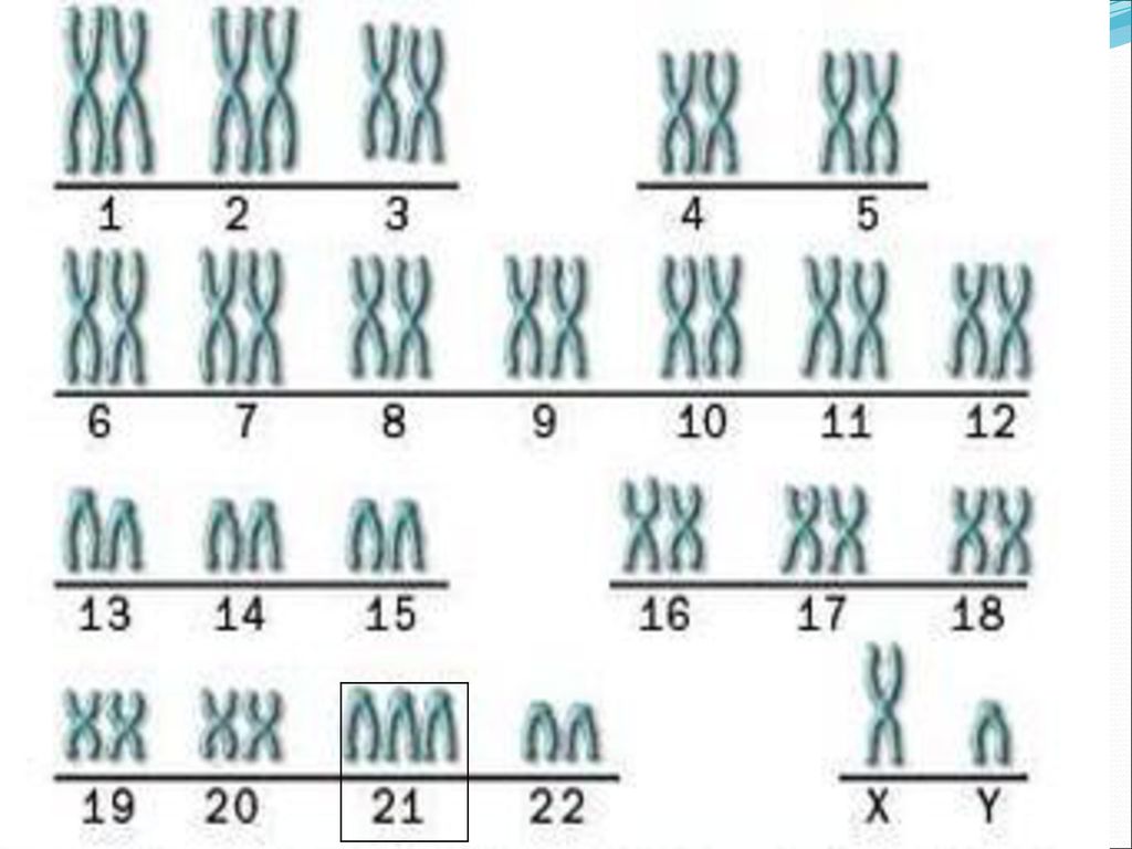В гаметах человека 23 хромосомы. Набор хромосом при синдроме Дауна. Набор хромосом у человека с синдромом Дауна. Синдром Дауна 21 хромосома. Синдром Дауна схема хромосом.
