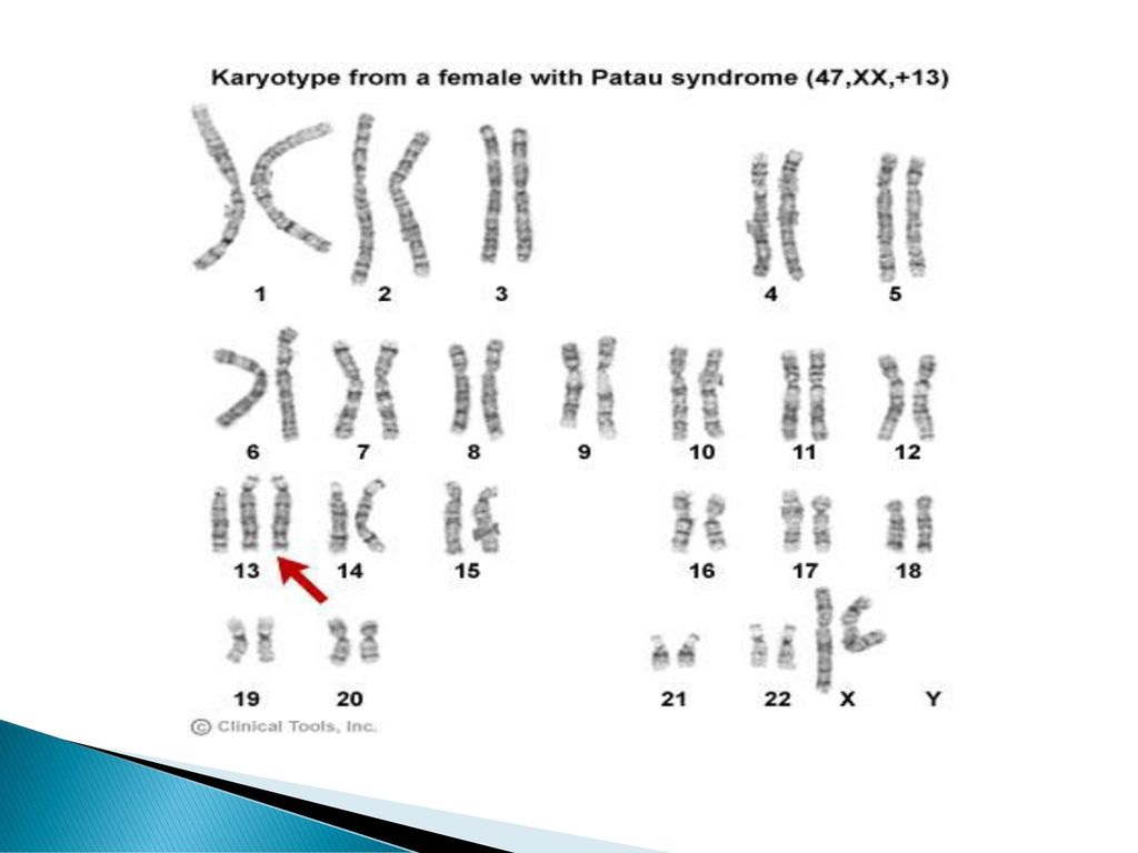 Схема хромосомного набора. Кариограмма синдрома Эдвардса. Синдром Патау (трисомия 13-й хромосомы). Кариотип человека с синдромом Эдвардса. Нормальный кариотип человека 46 хромосом.