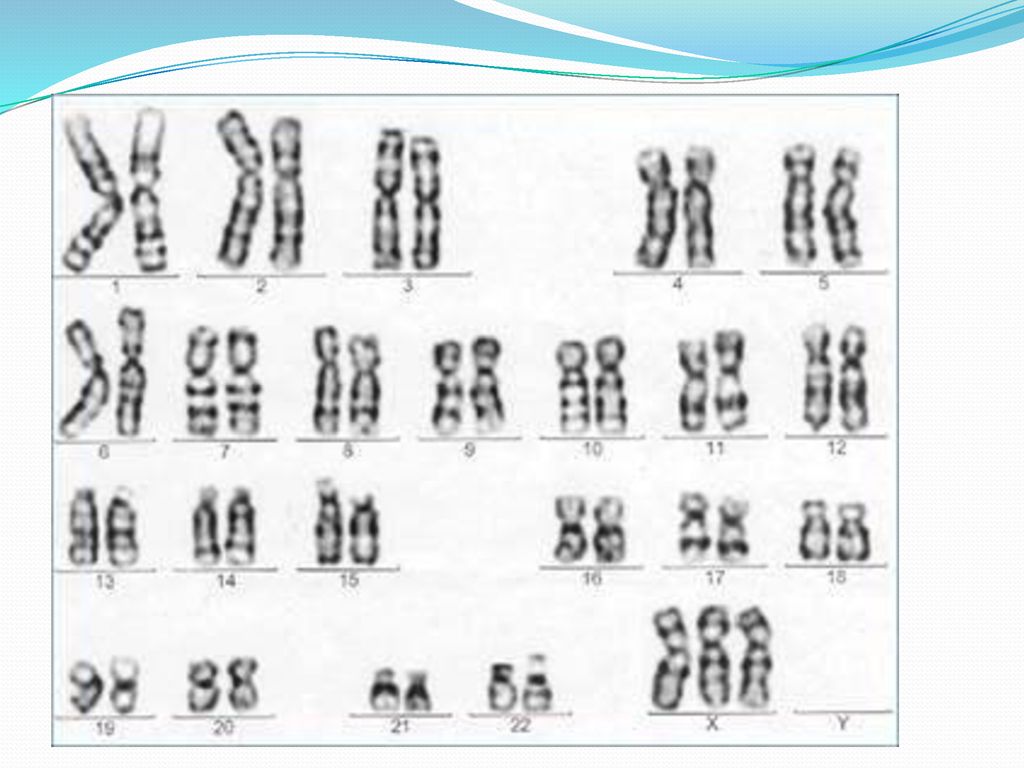Хромосома фенотип. Синдром трисомии х кариотип. Кариотип синдрома трисомии х хромосомы. Синдром трисомии х хромосомы. Синдром трисомии x кариотип.