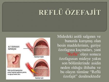 Midedeki asitli salgının ve bununla karışmış olan besin maddelerinin, geriye özofagusa kaçmaları, yani “Reflü” olayı sonucu özofagusun mideye yakın son.