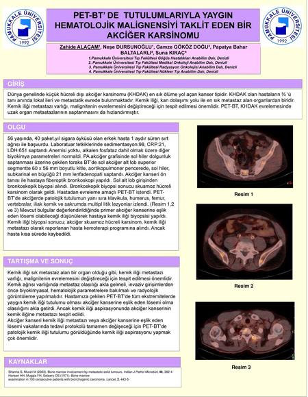 F PET-BT’ DE TUTULUMLARIYLA YAYGIN HEMATOLOJİK MALİGNENSİYİ TAKLİT EDEN BİR AKCİĞER KARSİNOMU Zahide ALAÇAM¹, Neşe DURSUNOĞLU¹, Gamze GÖKÖZ DOĞU², Papatya.