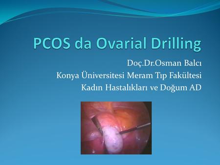 PCOS da Ovarial Drilling