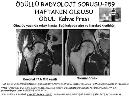 Otuz üç yaşında erkek hasta. Sağ kalçada ağrı ve hareket kısıtlılığı.