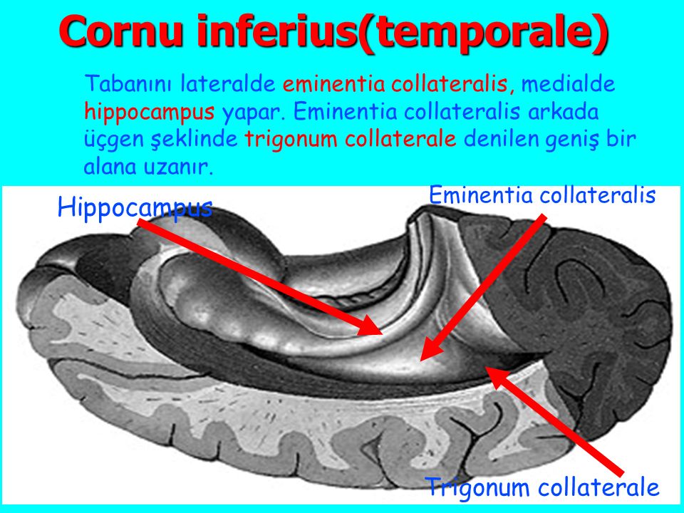 Cornu inferius(temporale)