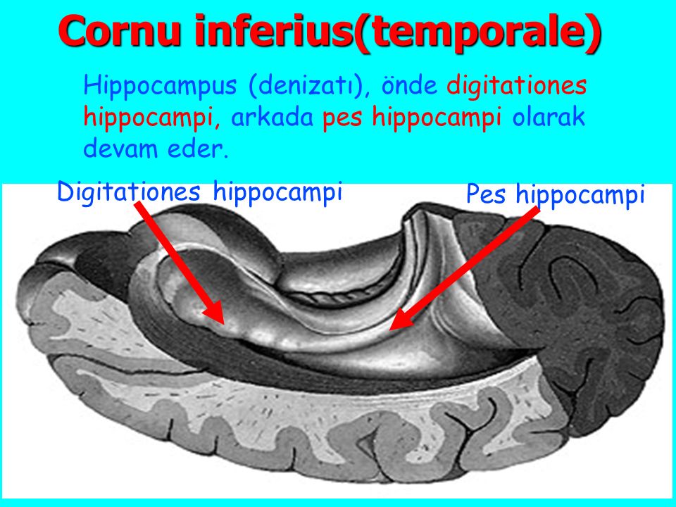 Cornu inferius(temporale)