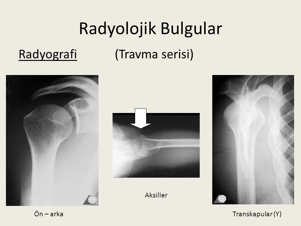 Radyolojik Bulgular Radyografi (Travma serisi) Aksiller Ön – arka