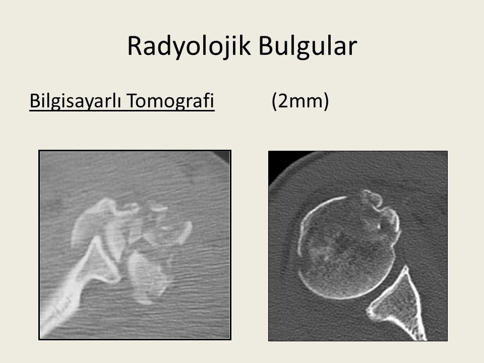 Radyolojik Bulgular Bilgisayarlı Tomografi (2mm)