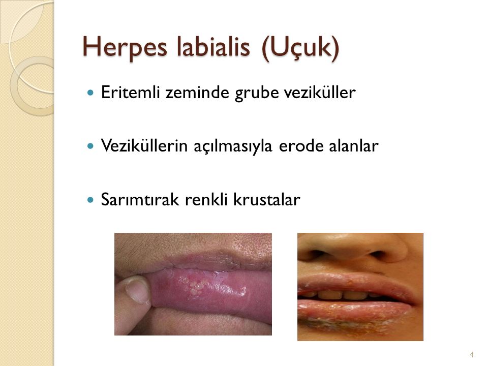 Herpes labialis (Uçuk) .