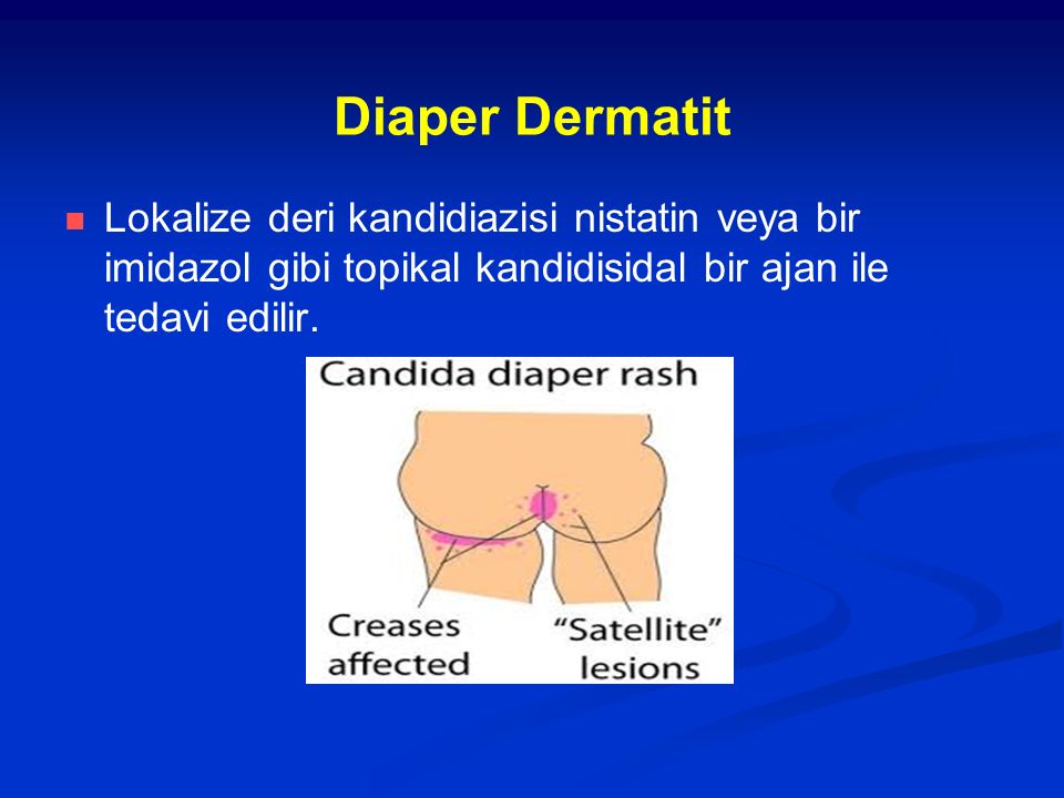 Diaper Dermatit Lokalize deri kandidiazisi nistatin veya bir imidazol gibi topikal kandidisidal bir ajan ile tedavi edilir.