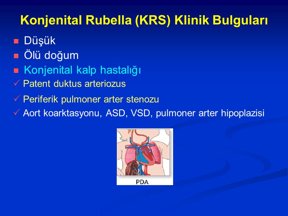 Konjenital Rubella (KRS) Klinik Bulguları
