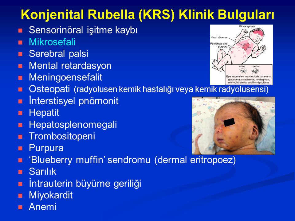 Konjenital Rubella (KRS) Klinik Bulguları