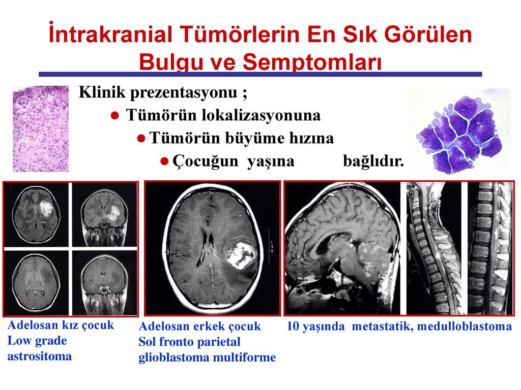 Çocukluk Çağı Santral Sinir Sistemi Tümörleri Ppt Indir 7885