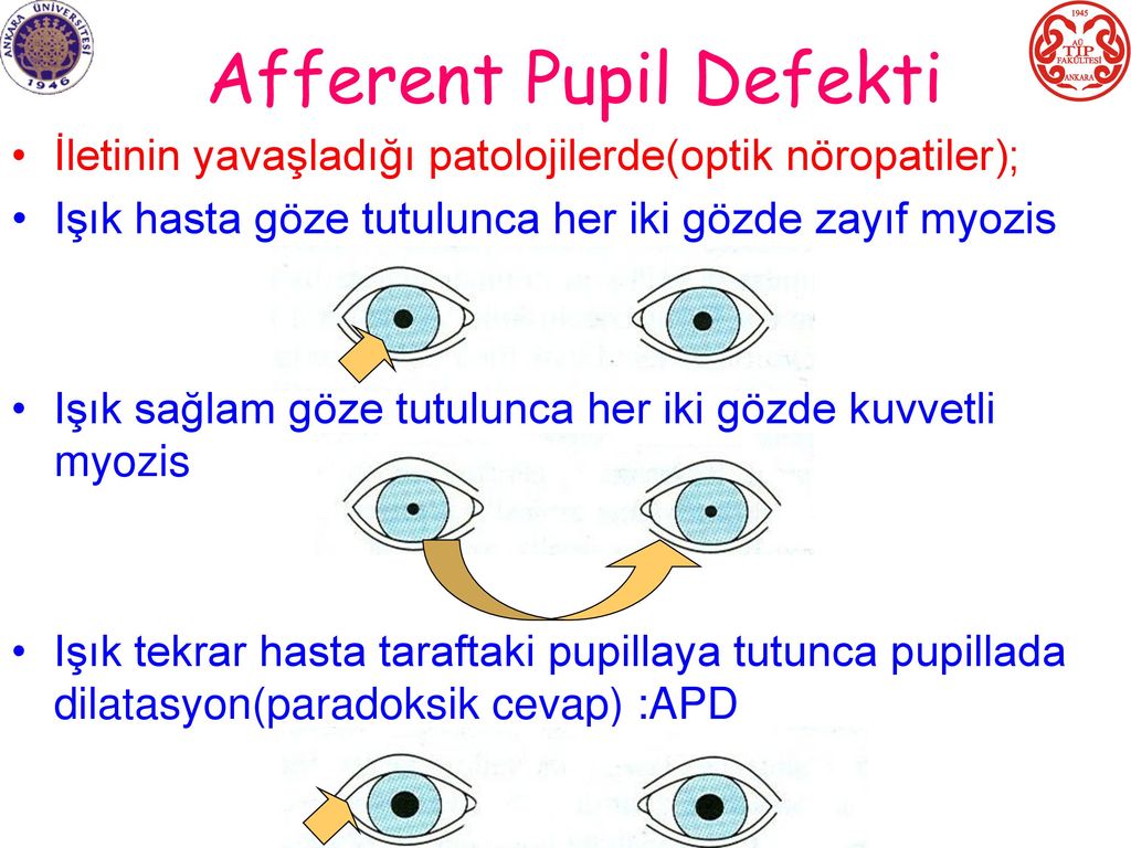 Afferent Pupil Defekti