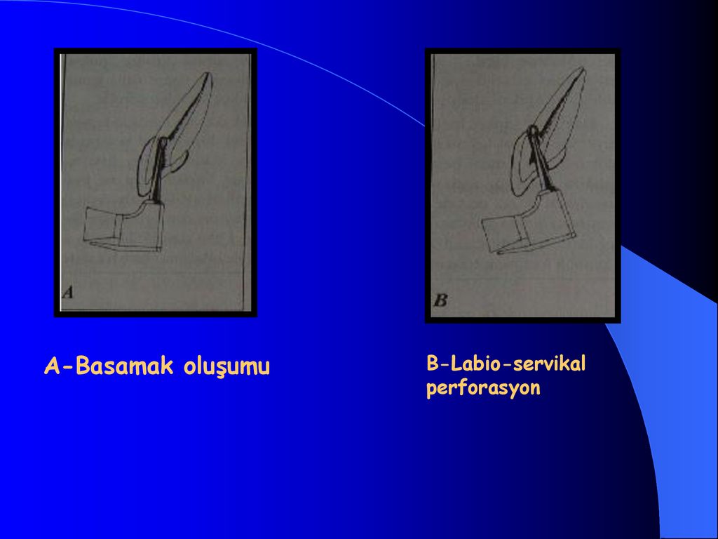 A-Basamak oluşumu B-Labio-servikal perforasyon