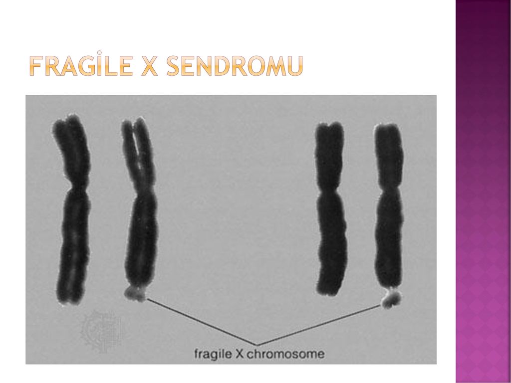 Спаривание хромосом. Синдрома фрагильной x-хромосомы. Синдром ломкой х-хромосомы.
