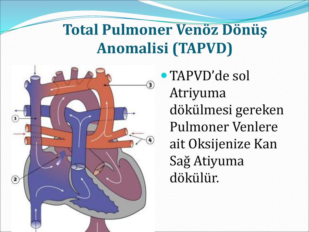 Sİyanotİk DoĞumsal Kalp Hastaliklarina YaklaŞim - Ppt Indir