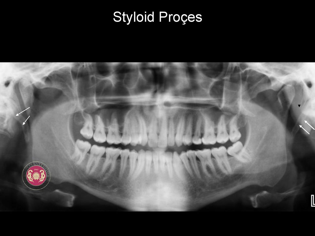 Styloid Proçes