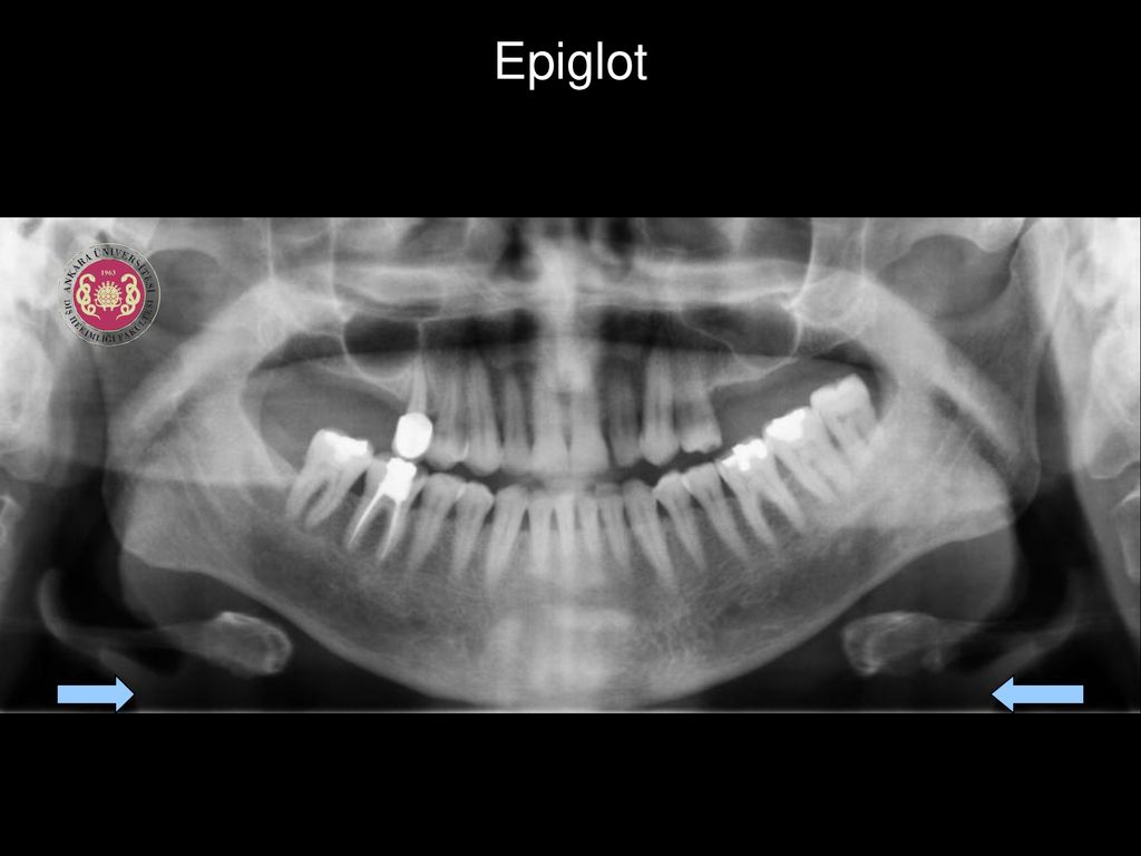Epiglot