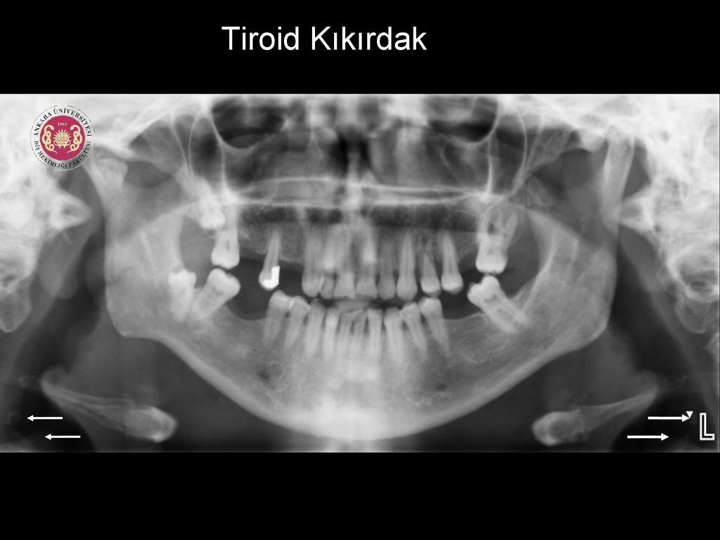 Tiroid Kıkırdak