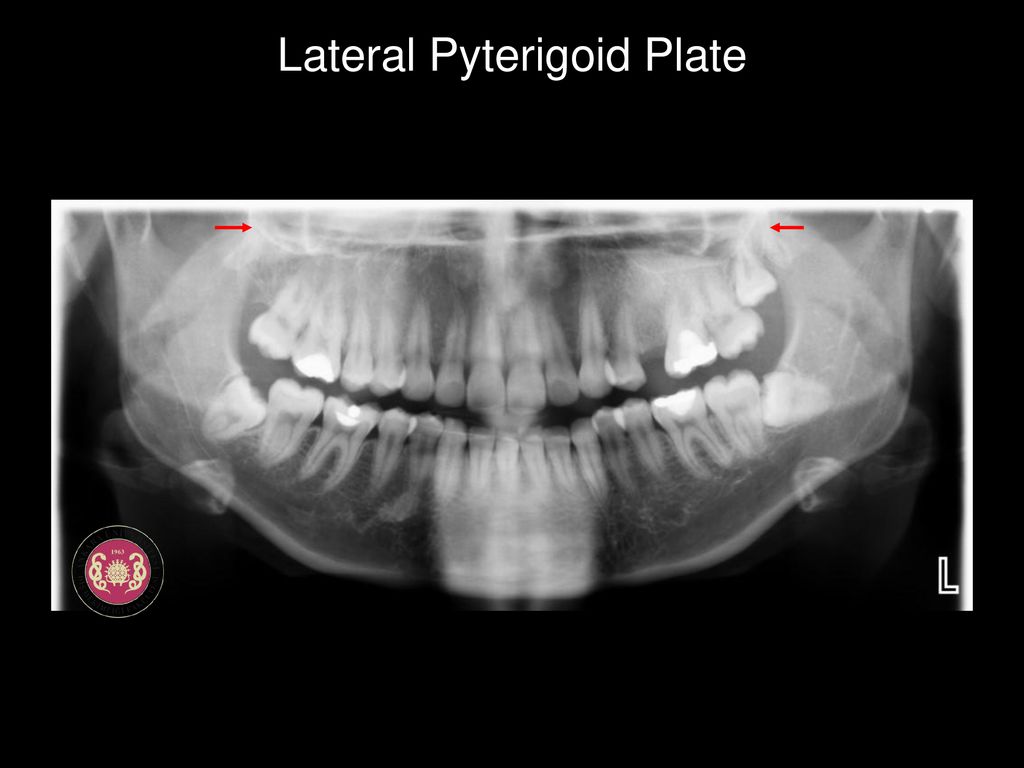 Lateral Pyterigoid Plate