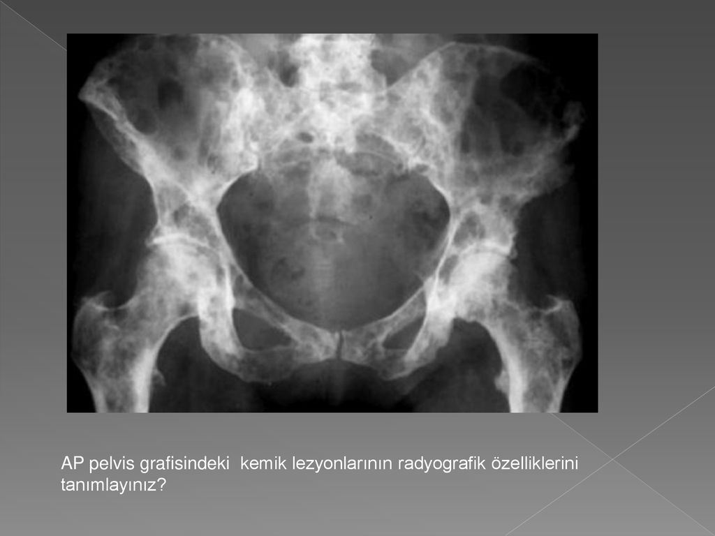 Метастазы в кости при раке предстательной. Остеобластические метастазы в кости таза рентген. Остеолитические метастазы в костях таза кт. Гигантоклеточная опухоль таза кт. Остеобластические метастазы костей таза на рентгене.