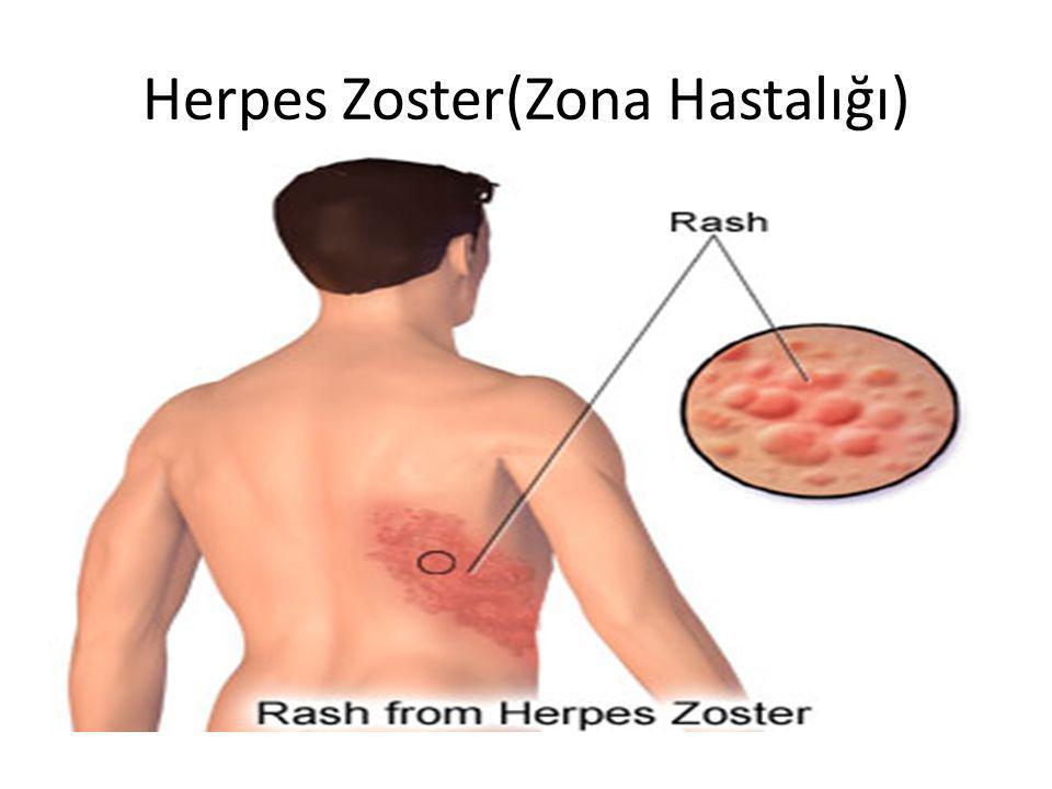 Herpes Zoster(Zona Hastalığı)