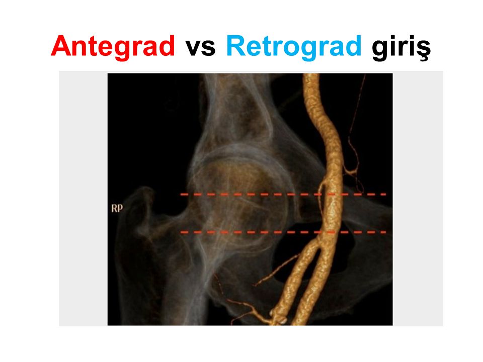Antegrad vs Retrograd giriş