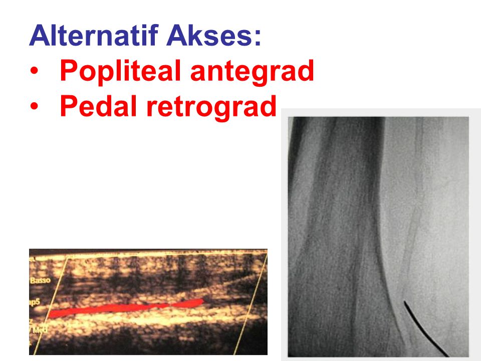 Alternatif Akses: Popliteal antegrad Pedal retrograd