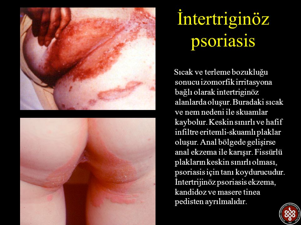İntertriginöz psoriasis