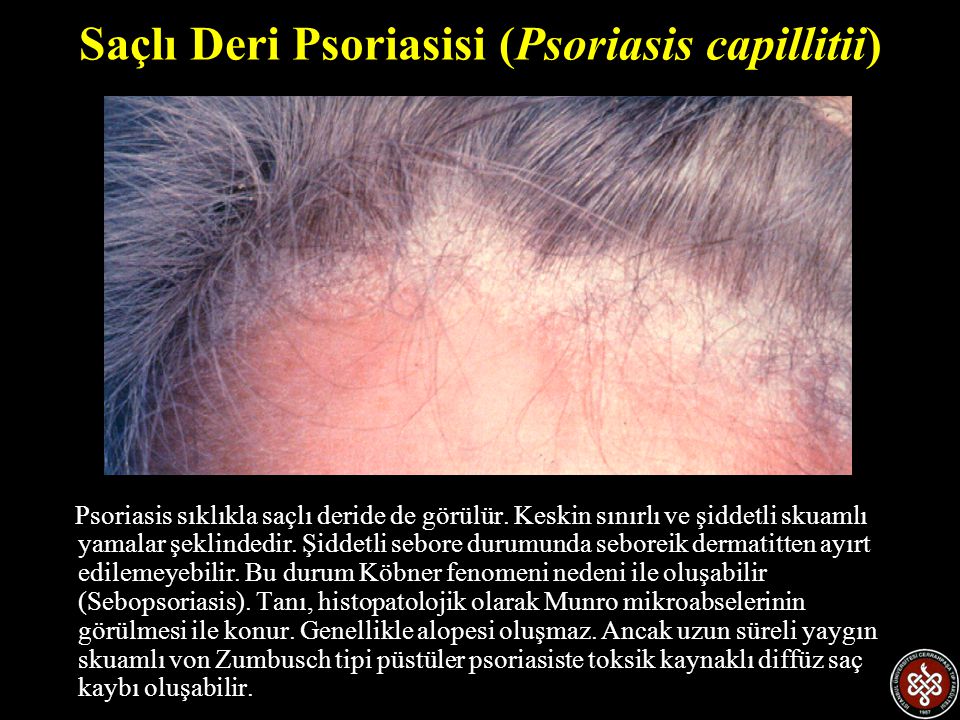 Saçlı Deri Psoriasisi (Psoriasis capillitii)