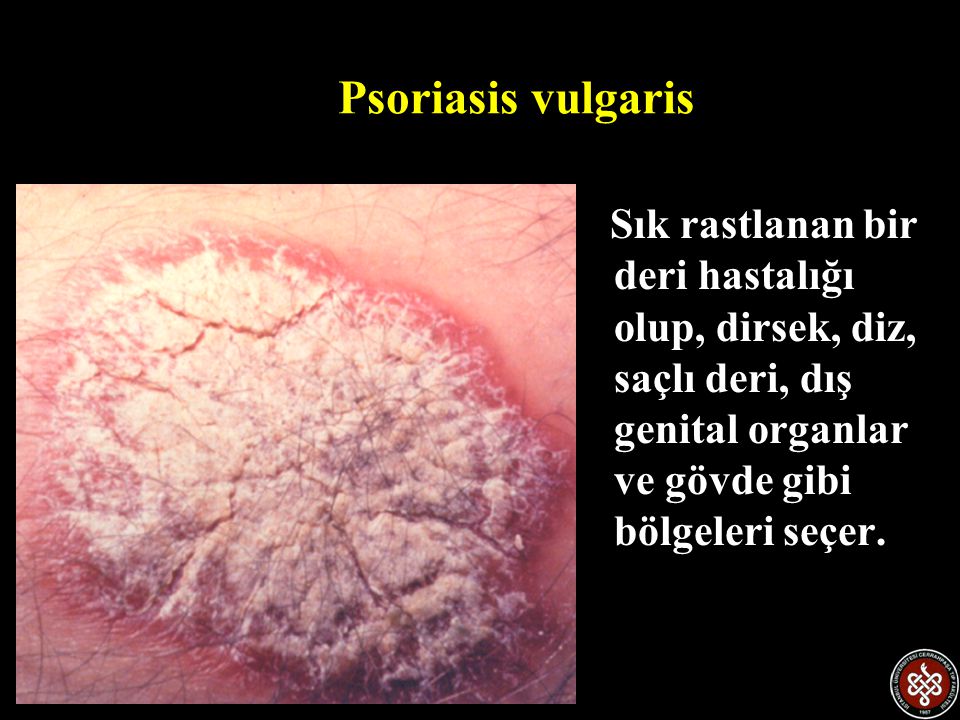 Psoriasis vulgaris Sık rastlanan bir deri hastalığı olup, dirsek, diz, saçlı deri, dış genital organlar ve gövde gibi bölgeleri seçer.