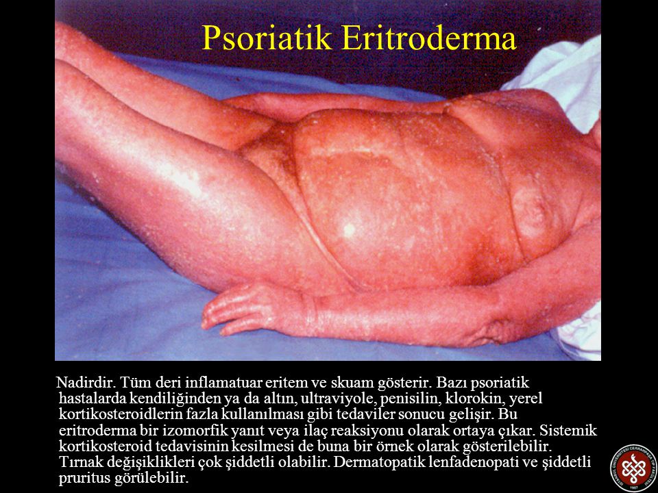 Psoriatik Eritroderma