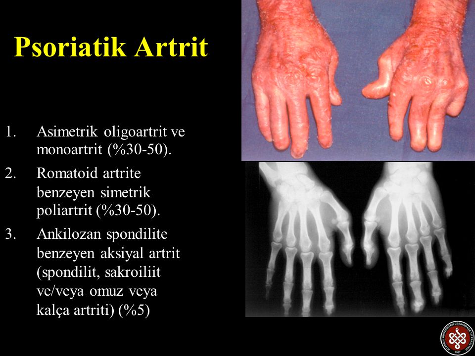 Psoriatik Artrit Asimetrik oligoartrit ve monoartrit (%30-50).