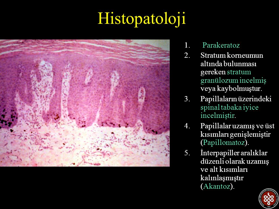 Histopatoloji Parakeratoz