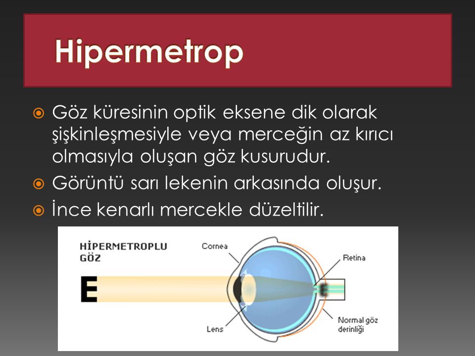 Hipermetrop Göz küresinin optik eksene dik olarak şişkinleşmesiyle veya merceğin az kırıcı olmasıyla oluşan göz kusurudur.